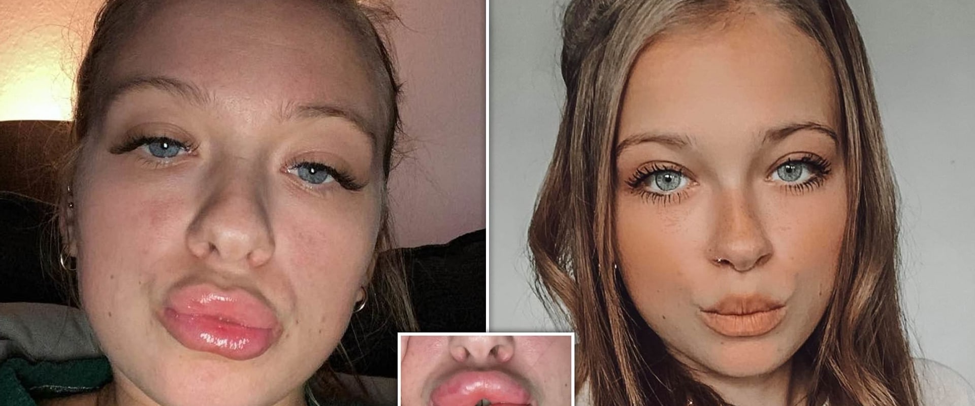 lip-fillers-before-and-after-healthy-b-daily