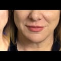 Smoothing Smokers Lines with Dermal Fillers