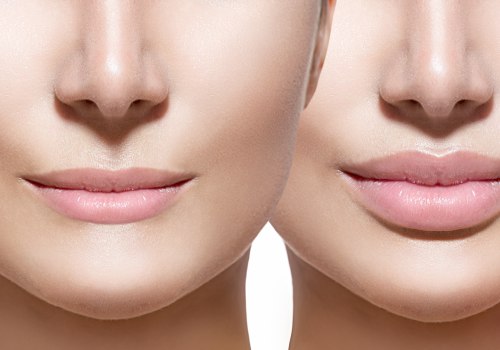 Who are the Professionals that Administer Lip Fillers?