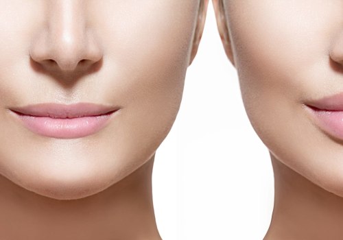 How long does juvederm last?