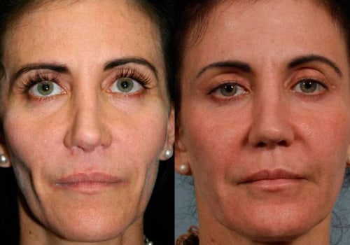 Do dermal fillers require a prescription?