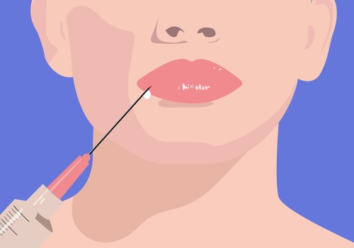 Where do fillers go in the face? a comprehensive guide