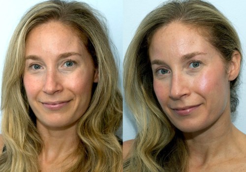 Do Dermal Fillers Look Better After a Few Days?