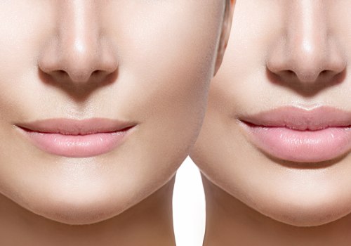 The Most Effective Dermal Fillers: A Comprehensive Guide